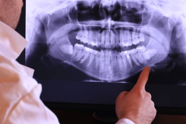 Best Emergency Wisdom Teeth Removal in Robstown, TX